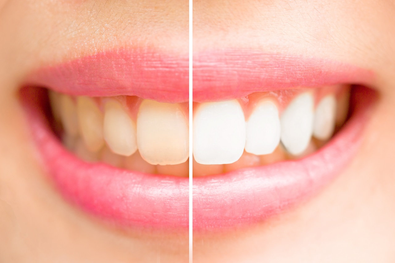 Wybielanie zębów – kto powinien zdecydować się na taki zabieg?